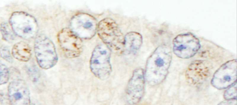 SNW1 / SKIP Antibody - Detection of Human NCOA62 by Immunohistochemistry. Sample: FFPE section of human prostate carcinoma. Antibody: Affinity purified rabbit anti-NCOA62 used at a dilution of 1:1000 (1 ug/ml). Detection: DAB.