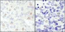SNW1 / SKIP Antibody - Detection of Human and Mouse NCOA62 by Immunohistochemistry. Sample: FFPE section of human breast carcinoma (left) and mouse teratoma (right). Antibody: Affinity purified rabbit anti-NCOA62 used at a dilution of 1:200 (1 ug/ml). Detection: DAB.