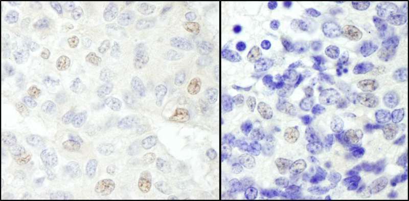 SNW1 / SKIP Antibody - Detection of Human and Mouse NCOA62 by Immunohistochemistry. Sample: FFPE section of human breast carcinoma (left) and mouse teratoma (right). Antibody: Affinity purified rabbit anti-NCOA62 used at a dilution of 1:200 (1 ug/ml). Detection: DAB.