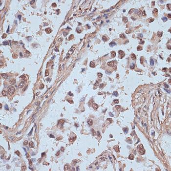 SNW1 / SKIP Antibody - Immunohistochemistry of paraffin-embedded Human lung cancer using SNW1 Polyclonal Antibody at dilution of 1:100 (40x lens).