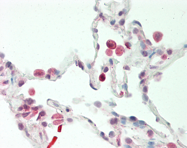 SNX1 Antibody - Human Lung: Formalin-Fixed, Paraffin-Embedded (FFPE).  This image was taken for the unconjugated form of this product. Other forms have not been tested.