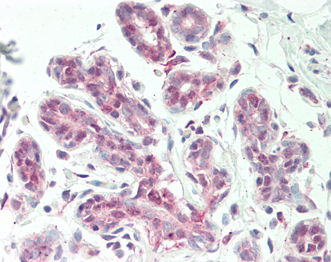 SNX1 Antibody - Human Breast: Formalin-Fixed, Paraffin-Embedded (FFPE).  This image was taken for the unconjugated form of this product. Other forms have not been tested.