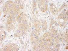 SNX1 Antibody - Detection of Human SNX1 by Immunohistochemistry. Sample: FFPE section of human breast carcinoma. Antibody: Affinity purified rabbit anti-SNX1 used at a dilution of 1:250.