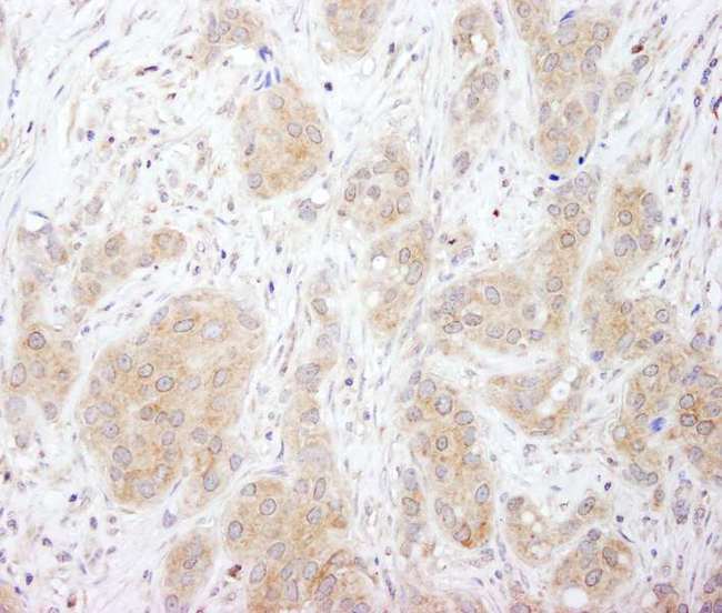 SNX1 Antibody - Detection of Human SNX1 by Immunohistochemistry. Sample: FFPE section of human breast carcinoma. Antibody: Affinity purified rabbit anti-SNX1 used at a dilution of 1:1000 (1 Detection: DAB.