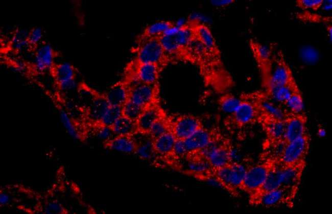 SNX1 Antibody - Detection of Human SNX1 by Immunofluorescence. Sample: FFPE section of human breast carcinoma. Antibody: Affinity purified rabbit anti-SNX1 used at a dilution of 1:400 (2.5 ug/ml). Detection: Red-fluorescent goat anti-rabbit IgG highly cross-adsorbed Antibody used at a dilution of 1:100.