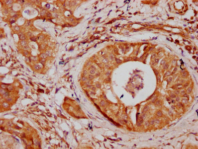 SNX10 Antibody - Immunohistochemistry Dilution at 1:300 and staining in paraffin-embedded human cervical cancer performed on a Leica BondTM system. After dewaxing and hydration, antigen retrieval was mediated by high pressure in a citrate buffer (pH 6.0). Section was blocked with 10% normal Goat serum 30min at RT. Then primary antibody (1% BSA) was incubated at 4°C overnight. The primary is detected by a biotinylated Secondary antibody and visualized using an HRP conjugated SP system.