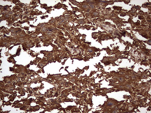SNX12 Antibody - Immunohistochemical staining of paraffin-embedded Adenocarcinoma of Human ovary tissue using anti-SNX12 mouse monoclonal antibody. (Heat-induced epitope retrieval by 1 mM EDTA in 10mM Tris, pH8.5, 120C for 3min,