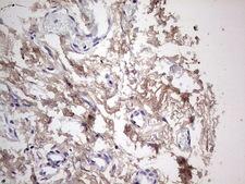 SNX12 Antibody - Immunohistochemical staining of paraffin-embedded Carcinoma of Human pancreas tissue using anti-SNX12 mouse monoclonal antibody. (Heat-induced epitope retrieval by 1 mM EDTA in 10mM Tris, pH8.5, 120C for 3min,