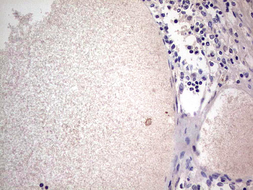 SNX12 Antibody - Immunohistochemical staining of paraffin-embedded Human thyroid tissue within the normal limits using anti-SNX12 mouse monoclonal antibody. (Heat-induced epitope retrieval by 1 mM EDTA in 10mM Tris, pH8.5, 120C for 3min,