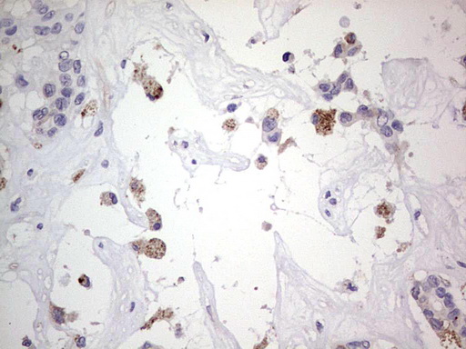 SNX12 Antibody - Immunohistochemical staining of paraffin-embedded Carcinoma of Human liver tissue using anti-SNX12 mouse monoclonal antibody. (Heat-induced epitope retrieval by 1 mM EDTA in 10mM Tris, pH8.5, 120C for 3min,