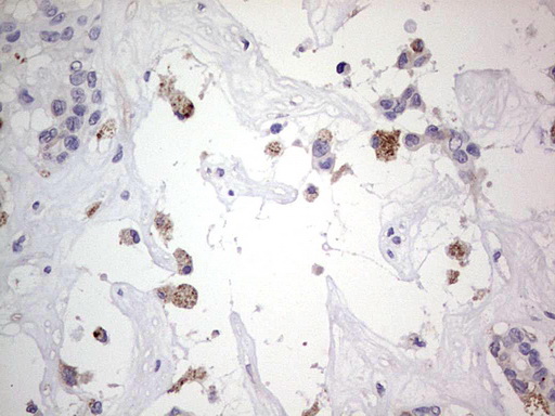 SNX12 Antibody - IHC of paraffin-embedded Carcinoma of Human liver tissue using anti-SNX12 mouse monoclonal antibody. (Heat-induced epitope retrieval by 1 mM EDTA in 10mM Tris, pH8.5, 120°C for 3min).