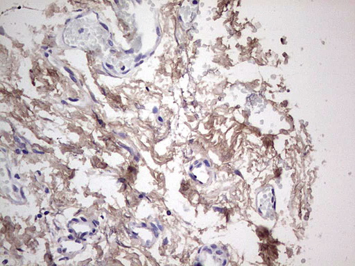 SNX12 Antibody - IHC of paraffin-embedded Carcinoma of Human pancreas tissue using anti-SNX12 mouse monoclonal antibody. (Heat-induced epitope retrieval by 1 mM EDTA in 10mM Tris, pH8.5, 120°C for 3min).