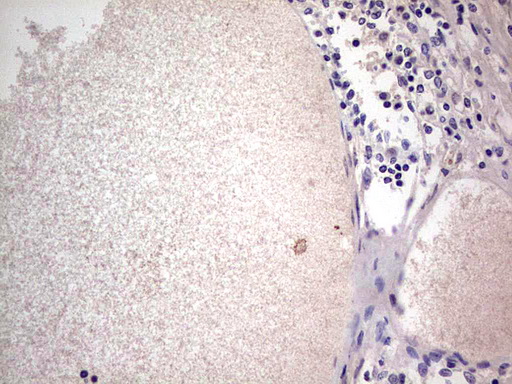 SNX12 Antibody - IHC of paraffin-embedded Human thyroid tissue using anti-SNX12 mouse monoclonal antibody. (Heat-induced epitope retrieval by 1 mM EDTA in 10mM Tris, pH8.5, 120°C for 3min).