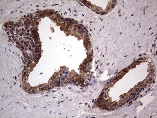SNX12 Antibody - IHC of paraffin-embedded Carcinoma of Human prostate tissue using anti-SNX12 Mouse monoclonal antibody. (heat-induced epitope retrieval by 1 mM EDTA in 10mM Tris, pH8.5, 120°C for 3min).