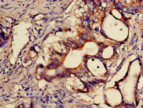 SNX15 Antibody - Immunohistochemistry of paraffin-embedded human colon cancer using SNX15 Antibody at dilution of 1:100