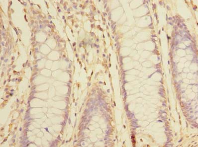 SNX16 Antibody - Immunohistochemistry of paraffin-embedded human colon cancer using antibody at dilution of 1:100.