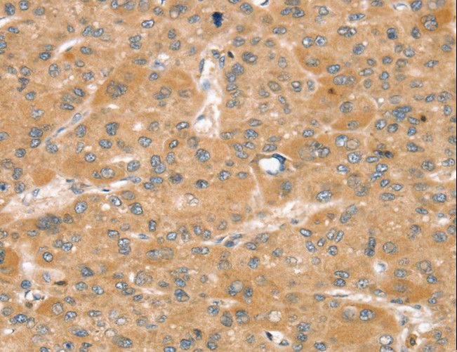 SNX2 Antibody - Immunohistochemistry of paraffin-embedded Human liver cancer using SNX2 Polyclonal Antibody at dilution of 1:40.