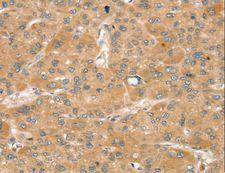 SNX2 Antibody - Immunohistochemistry of paraffin-embedded Human liver cancer using SNX2 Polyclonal Antibody at dilution of 1:40.