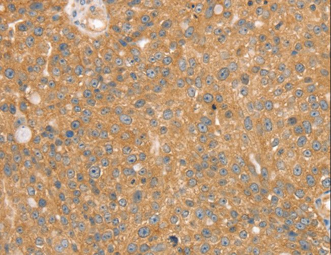SNX2 Antibody - Immunohistochemistry of paraffin-embedded Human breast cancer using SNX2 Polyclonal Antibody at dilution of 1:40.