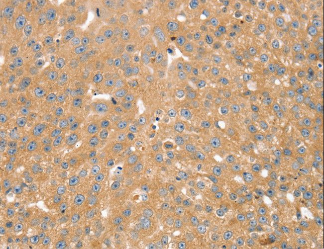 SNX2 Antibody - Immunohistochemistry of paraffin-embedded Human breast cancer using SNX2 Polyclonal Antibody at dilution of 1:40.