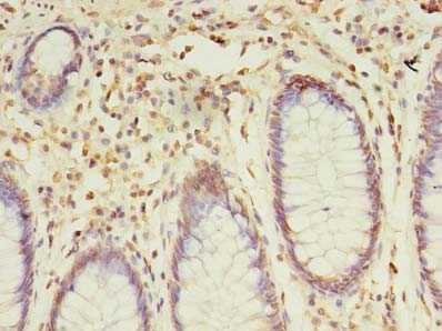 SNX24 Antibody - Immunohistochemistry of paraffin-embedded human colon cancer using antibody at dilution of 1:100.