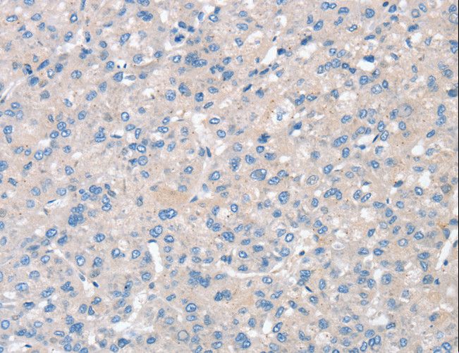 SNX3 Antibody - Immunohistochemistry of paraffin-embedded Human liver cancer using SNX3 Polyclonal Antibody at dilution of 1:30.