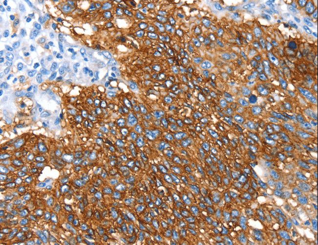 SNX5 Antibody - Immunohistochemistry of paraffin-embedded Human lung cancer using SNX5 Polyclonal Antibody at dilution of 1:30.