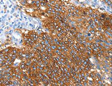 SNX5 Antibody - Immunohistochemistry of paraffin-embedded Human lung cancer using SNX5 Polyclonal Antibody at dilution of 1:30.