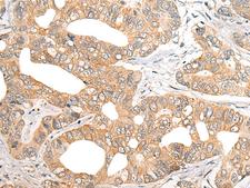 SNX6 Antibody - Immunohistochemistry of paraffin-embedded Human gastric cancer tissue  using SNX6 Polyclonal Antibody at dilution of 1:40(×200)