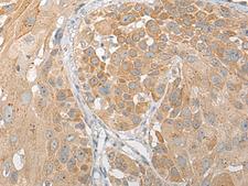 SNX6 Antibody - Immunohistochemistry of paraffin-embedded Human esophagus cancer tissue  using SNX6 Polyclonal Antibody at dilution of 1:50(×200)