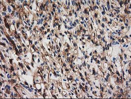 SNX8 Antibody - IHC of paraffin-embedded Carcinoma of Human kidney tissue using anti-SNX8 mouse monoclonal antibody.