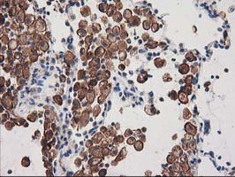 SNX8 Antibody - IHC of paraffin-embedded Carcinoma of Human lung tissue using anti-SNX8 mouse monoclonal antibody.