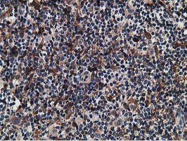 SNX8 Antibody - IHC of paraffin-embedded Human lymphoma tissue using anti-SNX8 mouse monoclonal antibody.