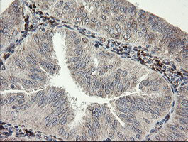 SNX8 Antibody - IHC of paraffin-embedded Adenocarcinoma of Human endometrium tissue using anti-SNX8 mouse monoclonal antibody.