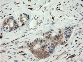 SNX8 Antibody - IHC of paraffin-embedded Adenocarcinoma of Human colon tissue using anti-SNX8 mouse monoclonal antibody.
