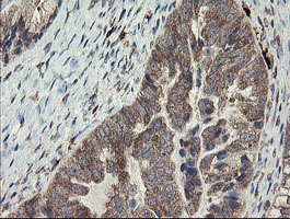 SNX8 Antibody - IHC of paraffin-embedded Adenocarcinoma of Human ovary tissue using anti-SNX8 mouse monoclonal antibody.