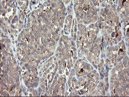 SNX8 Antibody - IHC of paraffin-embedded Carcinoma of Human thyroid tissue using anti-SNX8 mouse monoclonal antibody.