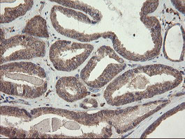 SNX8 Antibody - IHC of paraffin-embedded Carcinoma of Human prostate tissue using anti-SNX8 mouse monoclonal antibody.