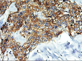 SNX8 Antibody - IHC of paraffin-embedded Adenocarcinoma of Human breast tissue using anti-SNX8 mouse monoclonal antibody.