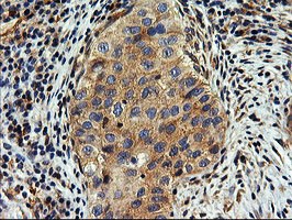 SNX8 Antibody - IHC of paraffin-embedded Carcinoma of Human bladder tissue using anti-SNX8 mouse monoclonal antibody.