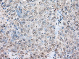 SNX9 / WISP Antibody - IHC of paraffin-embedded Adenocarcinoma of Human ovary tissue using anti-SNX9 mouse monoclonal antibody. (Dilution 1:50).