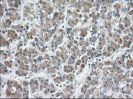 SNX9 / WISP Antibody - Immunohistochemical staining of paraffin-embedded Carcinoma of Human liver tissue using anti-SNX9 mouse monoclonal antibody. (Dilution 1:50).