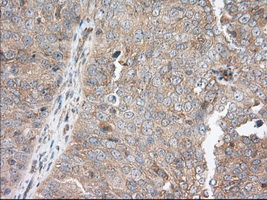 SNX9 / WISP Antibody - Immunohistochemical staining of paraffin-embedded Adenocarcinoma of Human ovary tissue using anti-SNX9 mouse monoclonal antibody. (Dilution 1:50).
