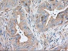 SNX9 / WISP Antibody - Immunohistochemical staining of paraffin-embedded Adenocarcinoma of Human colon tissue using anti-SNX9 mouse monoclonal antibody. (Dilution 1:50).