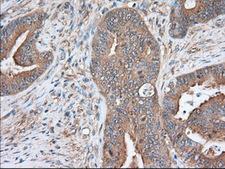 SNX9 / WISP Antibody - IHC of paraffin-embedded Adenocarcinoma of Human colon tissue using anti-SNX9 mouse monoclonal antibody. (Dilution 1:50).