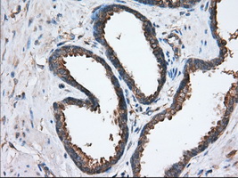 SNX9 / WISP Antibody - IHC of paraffin-embedded Carcinoma of Human prostate tissue using anti-SNX9 mouse monoclonal antibody. (Dilution 1:50).