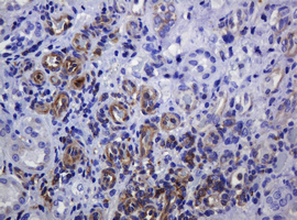 SOAT2 Antibody - IHC of paraffin-embedded Adenocarcinoma of Human colon tissue using anti-SOAT2 mouse monoclonal antibody.
