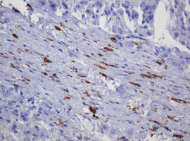 SOAT2 Antibody - IHC of paraffin-embedded Carcinoma of Human liver tissue using anti-SOAT2 mouse monoclonal antibody. (Heat-induced epitope retrieval by 10mM citric buffer, pH6.0, 120°C for 3min).