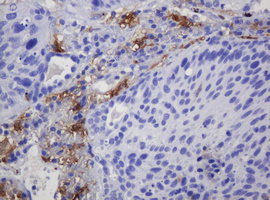 SOAT2 Antibody - IHC of paraffin-embedded Carcinoma of Human lung tissue using anti-SOAT2 mouse monoclonal antibody. (Heat-induced epitope retrieval by 10mM citric buffer, pH6.0, 120°C for 3min).