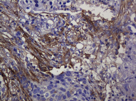 SOAT2 Antibody - IHC of paraffin-embedded Carcinoma of Human lung tissue using anti-SOAT2 mouse monoclonal antibody.